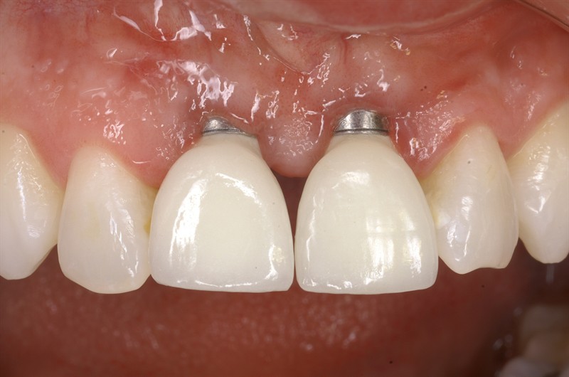 immediate-implants-how-to-manage-the-gap-teeth-and-titanium