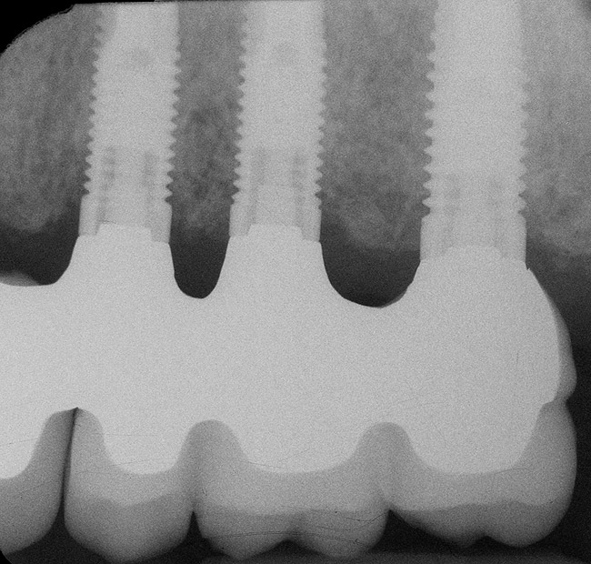 The Effect of Inter-Implant Distance on the Height of Inter-Implant Bone Crest
