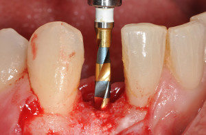 Dental Implants: Speed Matters