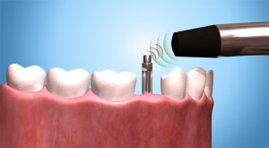 Implant Stability